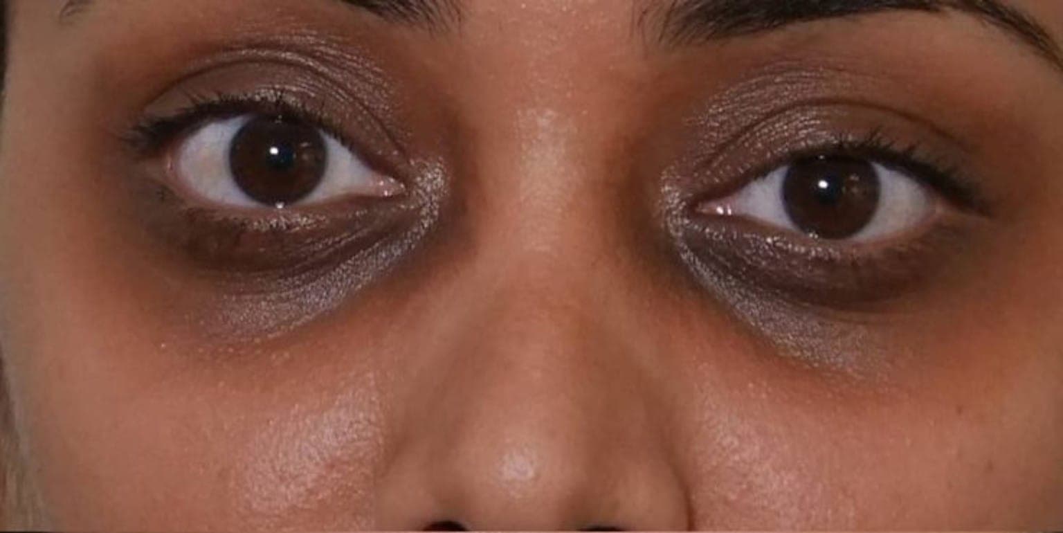 Ishita before using Dream Petals